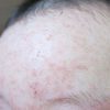 赤ちゃんの顔に赤い湿疹...乳児湿疹の原因や対策と症状別ケア方法！
