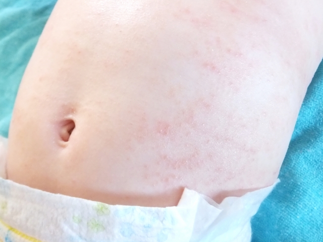 赤ちゃんの顔に赤い湿疹…乳児湿疹の原因や対策と症状別ケア方法！
